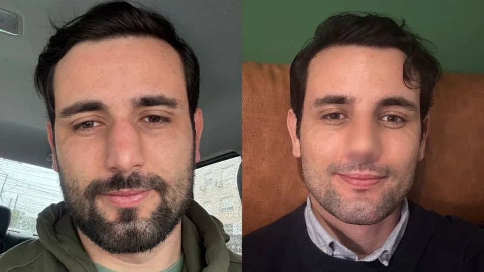 VÍDEO: ex-BBB Matteus Amaral mostra resultado de rinoplastia