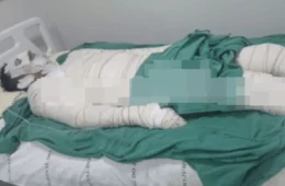 Trabalhador sofre graves queimaduras em incêndio a bordo de embarcação no interior do Acre