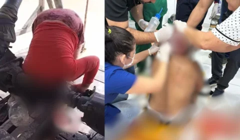 Jovem tem couro cabeludo arrancado ao prender cabelo em máquina no interior do Acre