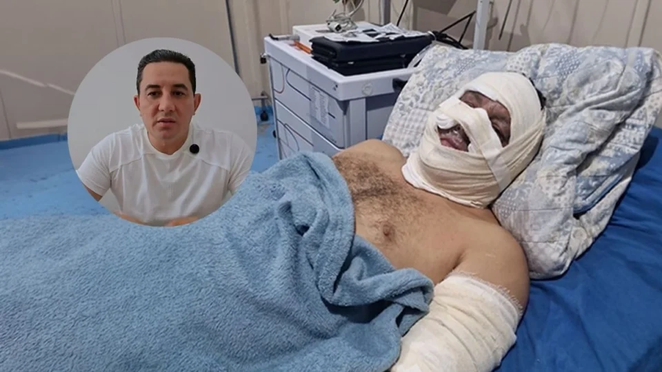 Ex-prefeito de Borba sofre queimaduras após explosão de lancha